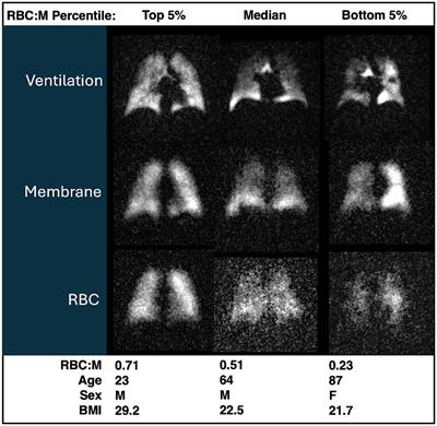 Functional gas exchange measures on 129Xe MRI and spectroscopy are associated with age, sex, and BMI in healthy subjects